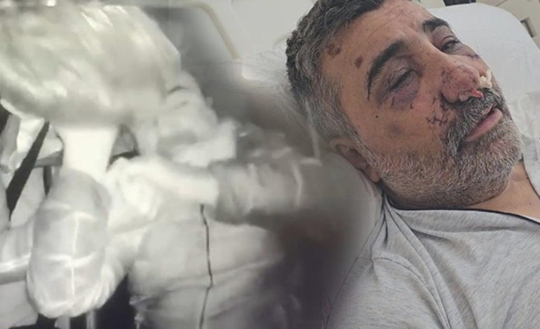 İngiliz boksörün öldüresiye dövdüğü taksici ilk kez konuştu! ‘Neden yaptığını anlamadım, beni öpmeye ve ısırmaya başladı’