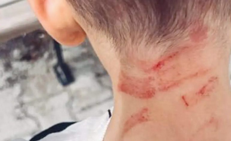 Burdur’da Özel Gereksinimli Çocuğa Darp İddiası: Soruşturma Başlatıldı