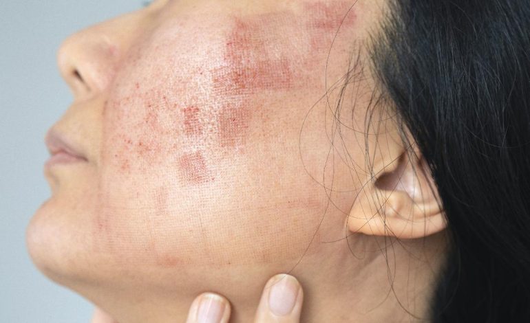 Lupus hastalığı hakkında bilmeniz gerekenler
