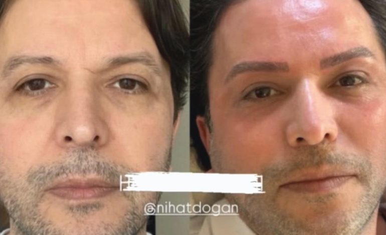 Nihat Doğan estetik işlem yaptırdı